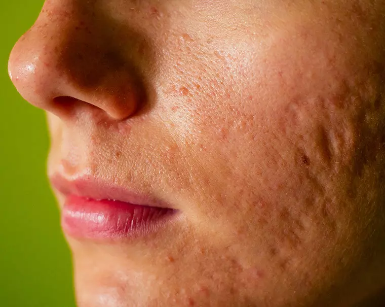 Akne - Årsager og behandling Akne - Årsager og behandling