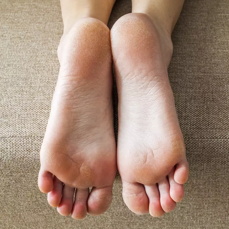 Sig farvel til hård hud - Sådan får du bløde fødder