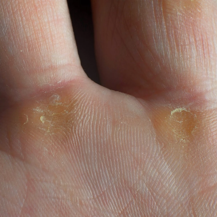 Sig farvel til hård hud - Sådan får du bløde fødder