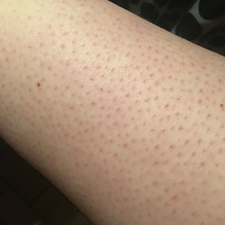 Keratosis pilaris - Sådan plejer du dine jordbærben