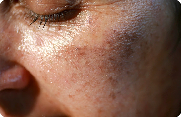 Sig farvel til pigmentpletter og ujævn hudtone