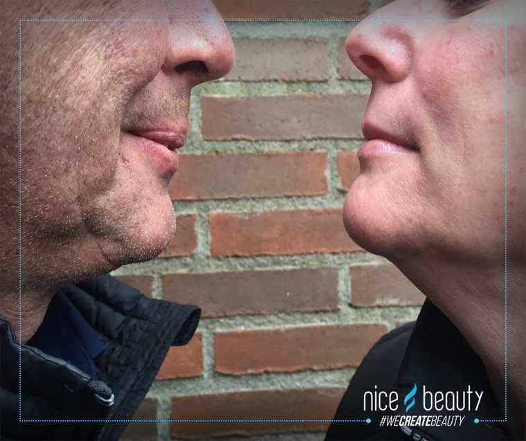 Rynker kvinders hud nemmere?