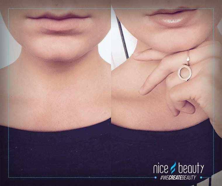 Gönne dir vollere Lippen!