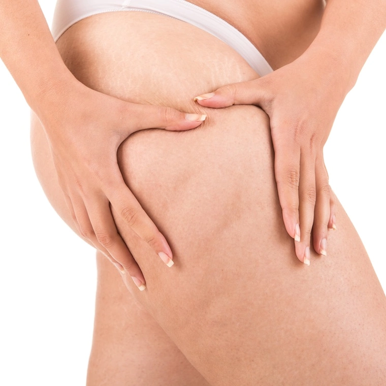 Hvordan slipper man af med appelsinhud?